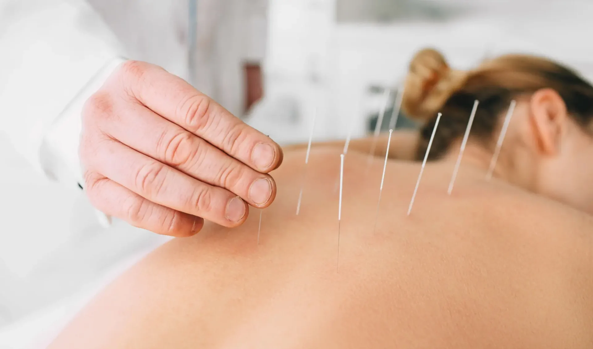Acupuncture needles inserted in patient's upper back