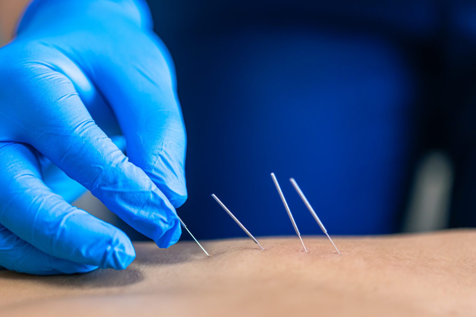 Gloved hand inserting acupuncture needles into skin