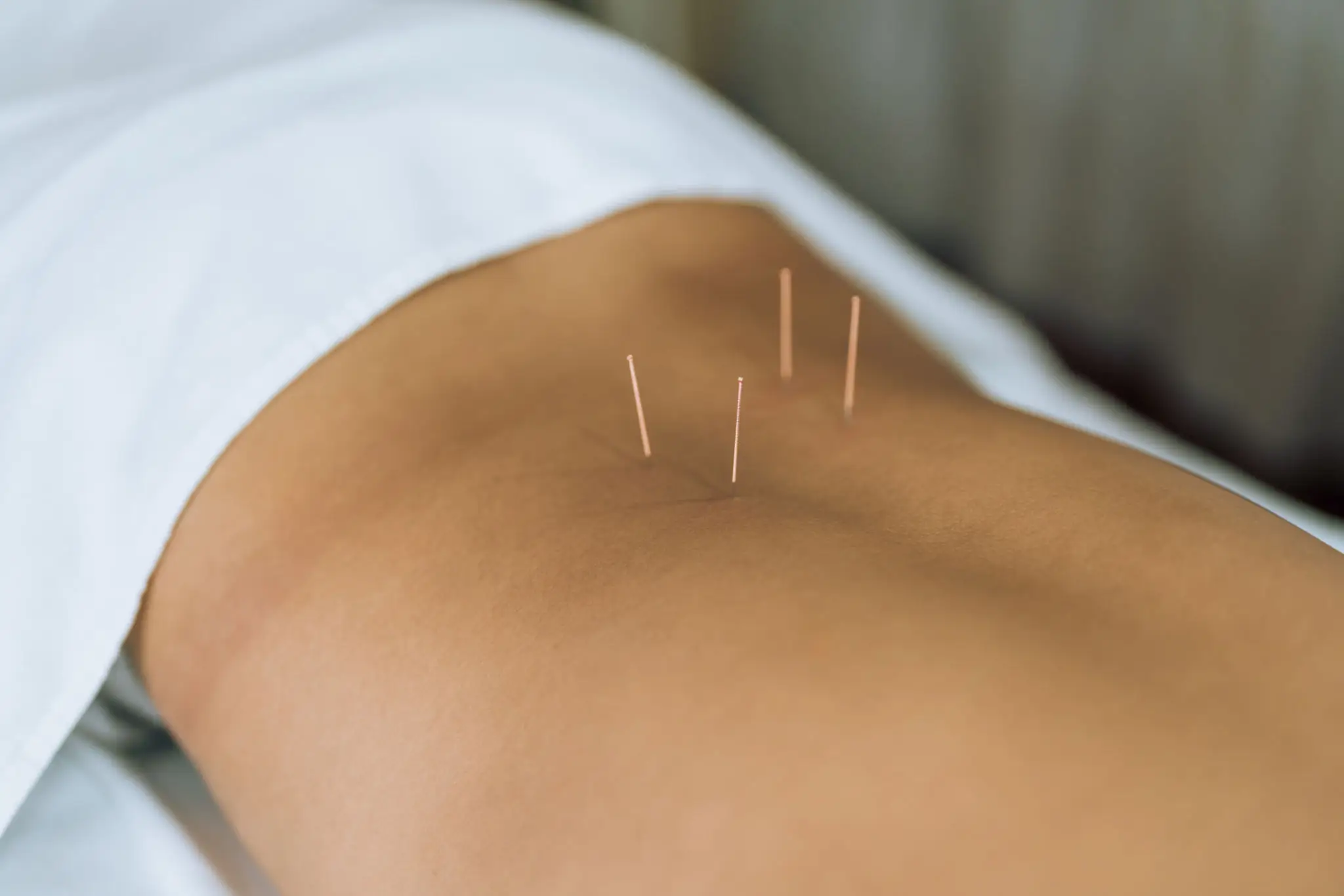 Acupuncture needles inserted in patient's lower back